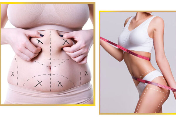 Safe and Effective Liposuction in Islamabad: What You Need to Know liposuction in islamabad