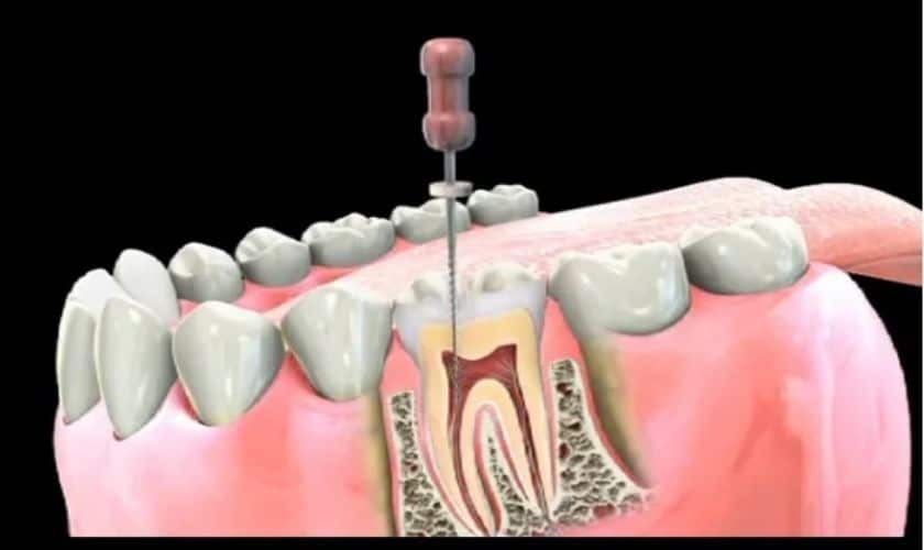 root canal pain