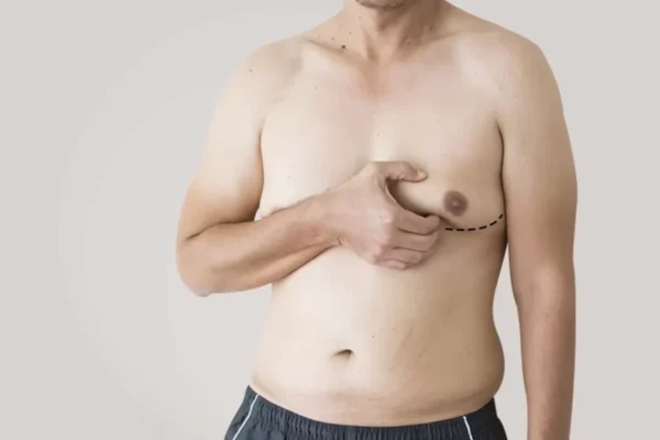 How Islamabad Gynecomastia Surgery Can Improve Your Confidence islamabad gynecomastia