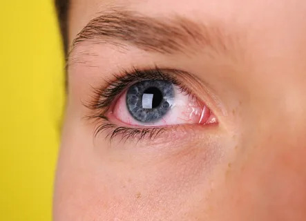 Pink Eye or Allergy? How to Know the Difference and Feel Better Fast pink eye