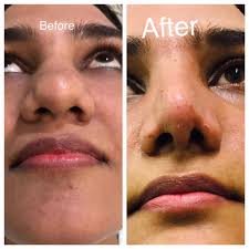 How Surgeons Decide Rhinoplasty Cost in Pakistan rhinoplasty cost in pakistan