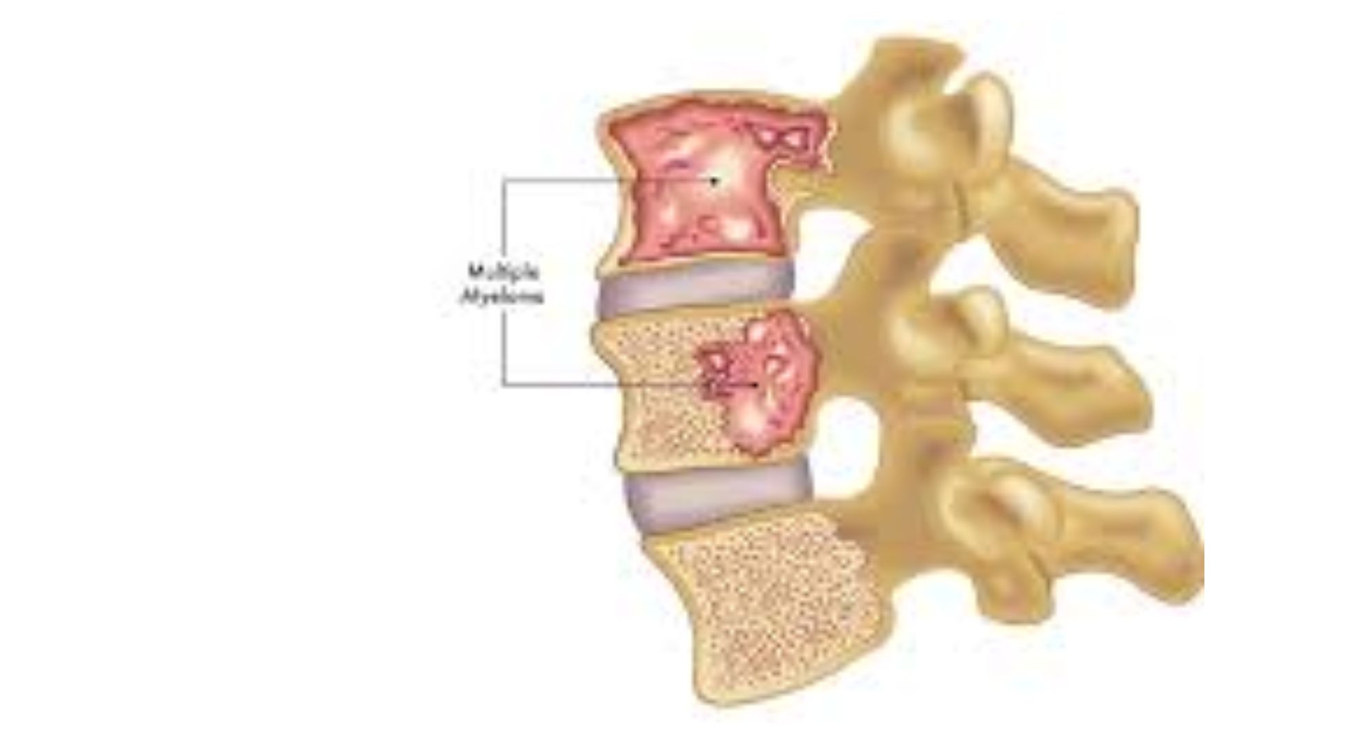 multiple Myeloma Treatment image