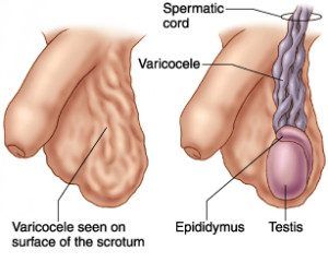 Top 10 Common Varicocele Symptoms and How to Identify Them