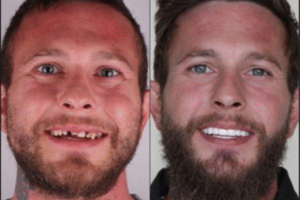 Say Goodbye to Double Chin – Transform Your Face with Reviv reviv