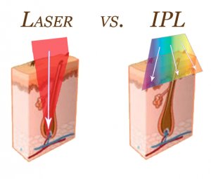 IPL vs. Laser Treatments