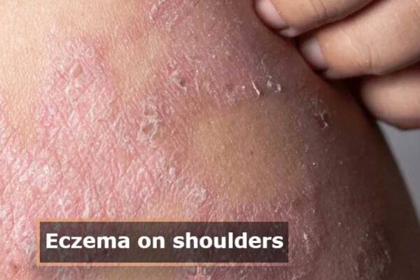 Eczema and Shoulder Pain: Understanding the Connection eczema on the shoulder