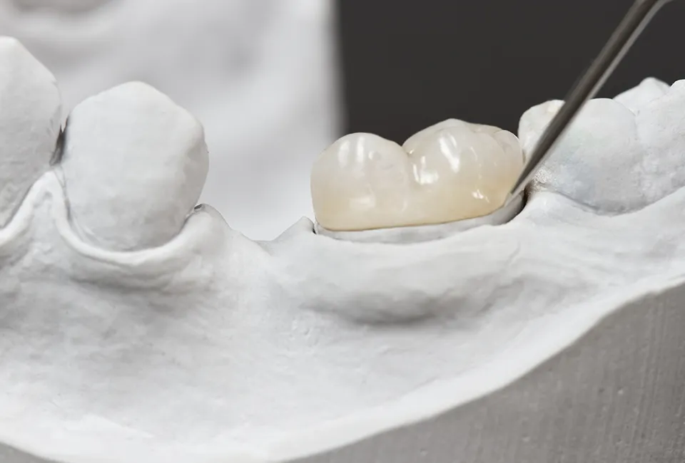 Teeth Grinding (Bruxism)