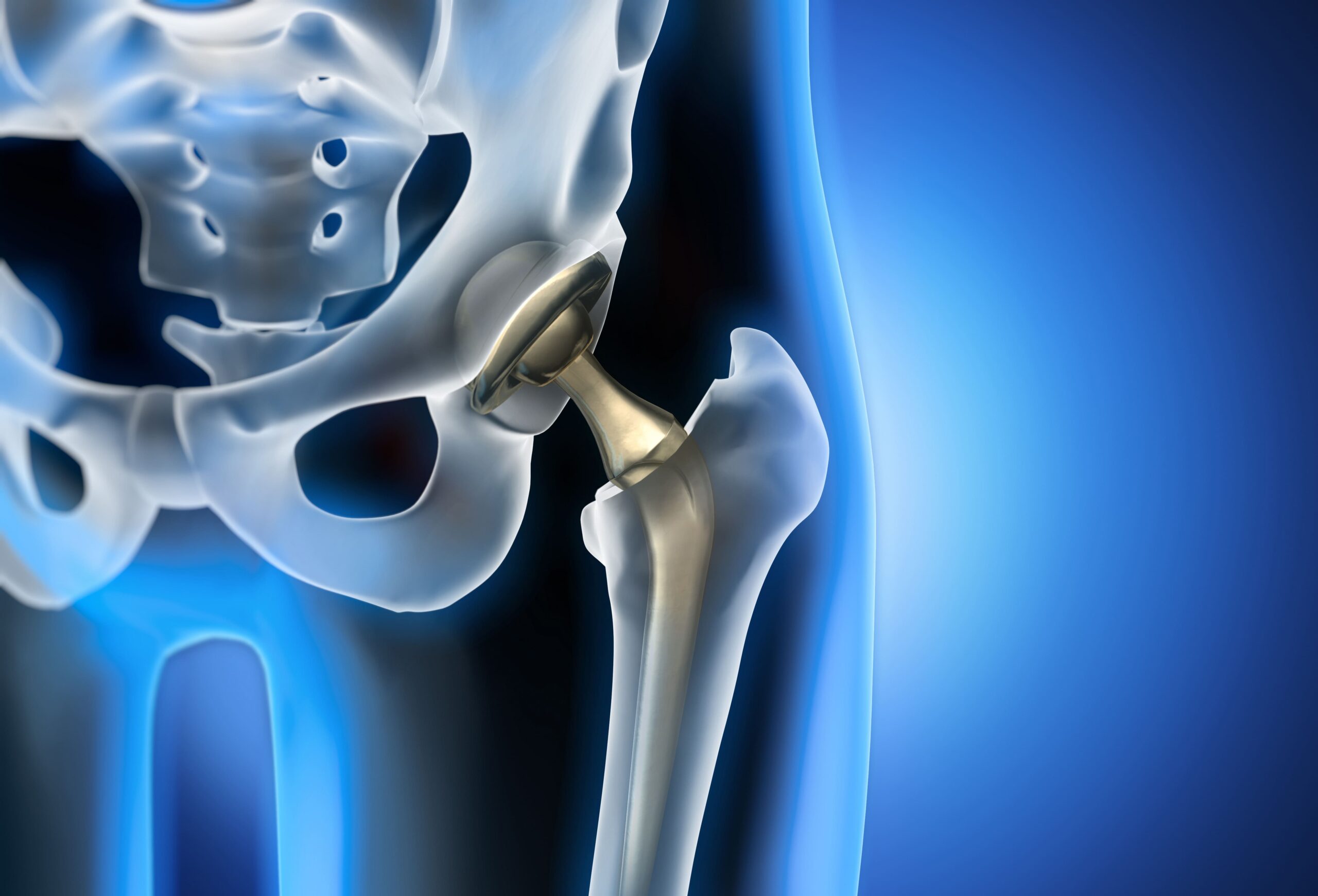 Hip Replacement